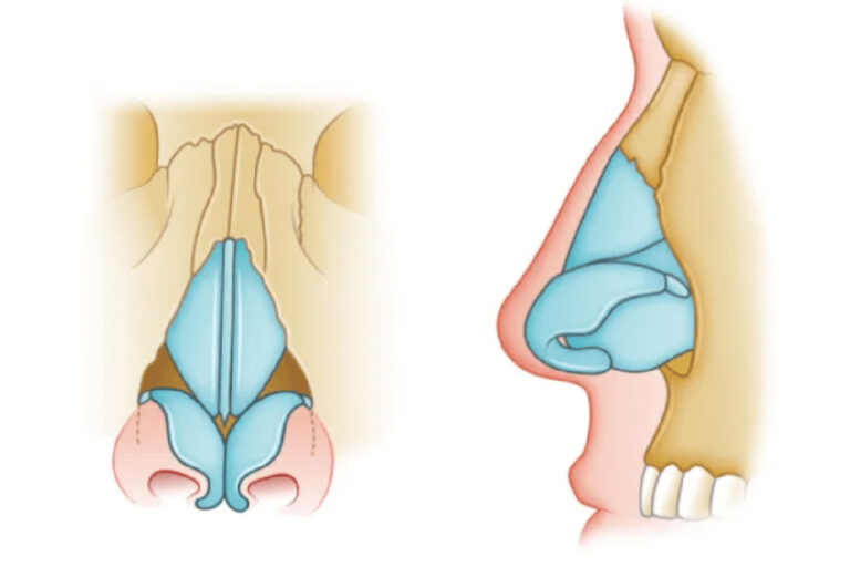 Nasal Fracture &ndash; ENT Specialists of Alberta